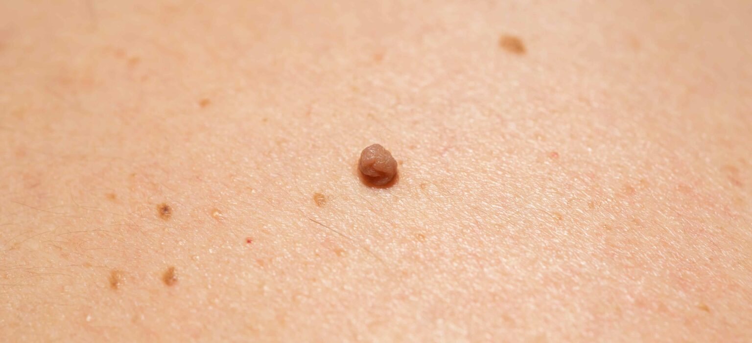 Comment se débarrasser de ses acrochordons, verrues séborrhéiques et grains de beauté ? Dr