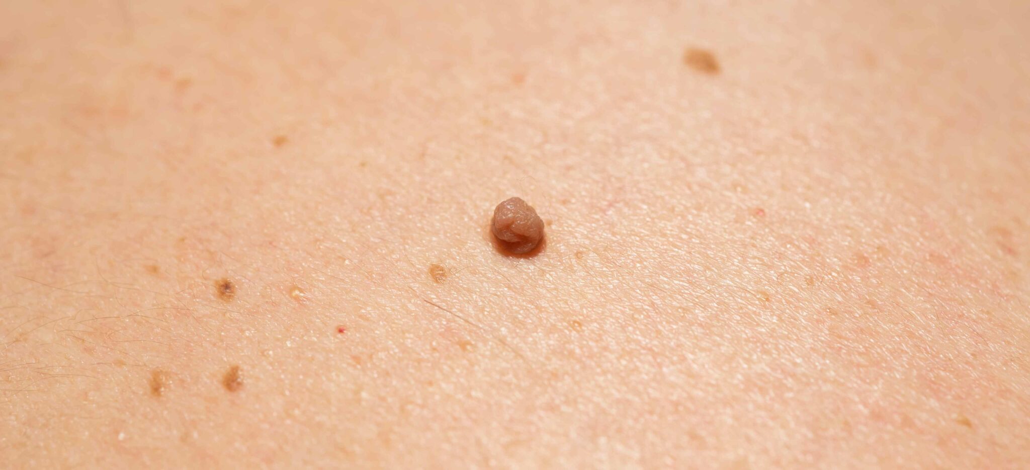 Comment se débarrasser de ses acrochordons, verrues séborrhéiques et grains de beauté ? Dr