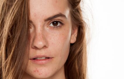 Effacer les taches sur le visage avec le Dr Mayeux à Paris